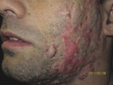verneuil-face-2